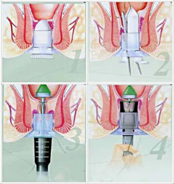 PPH微創技術治療肛瘺有奇